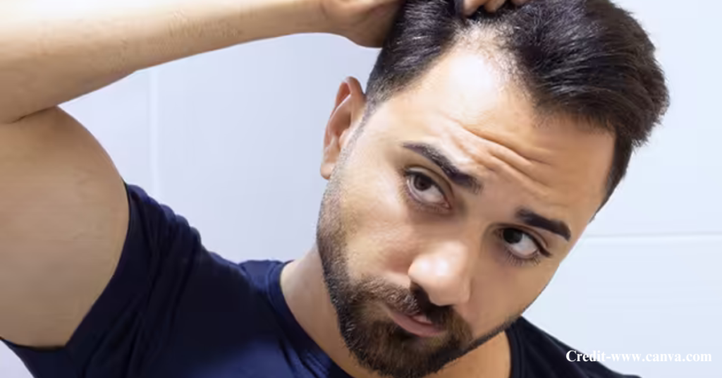 What Causes Dandruff and Hair Fall?