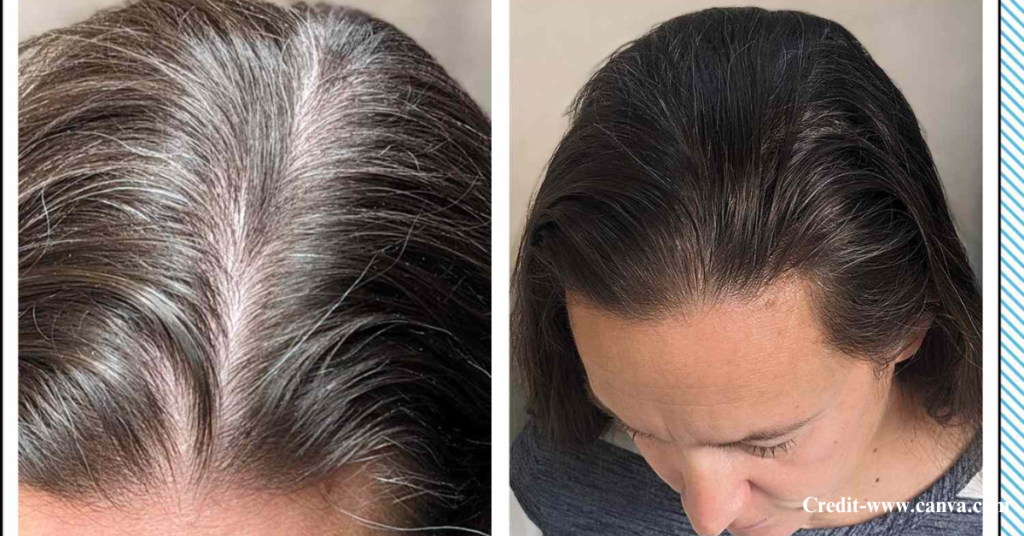 Natural Remedies for Dandruff and Hair Fall