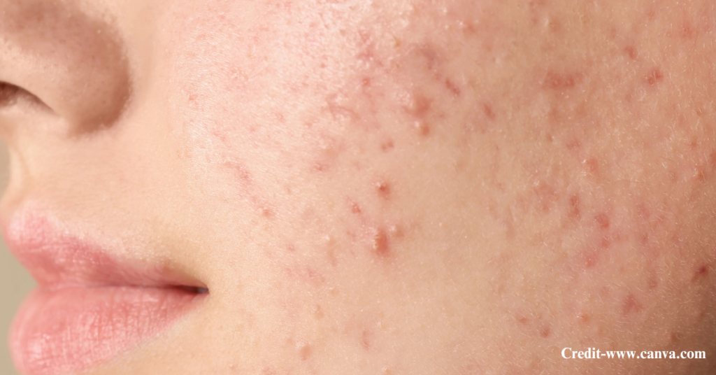 How to Remove Pimples for Good