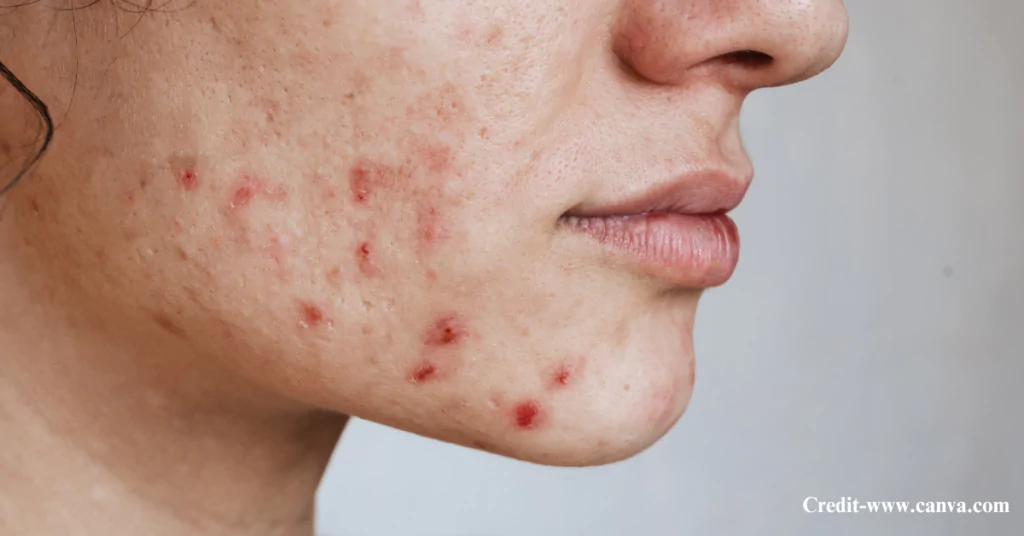 Benefits of Using Pimple Patches