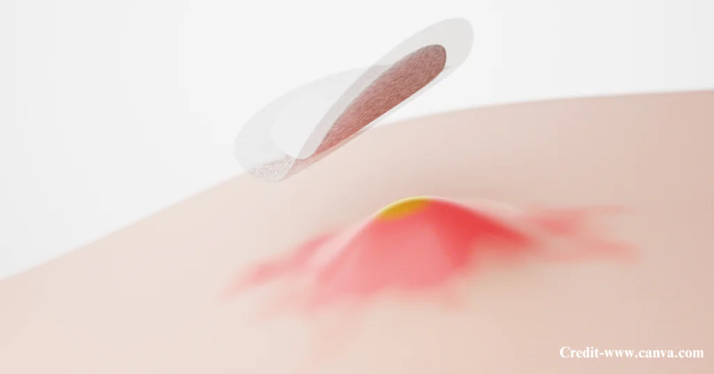 What Are Pimple Patches?