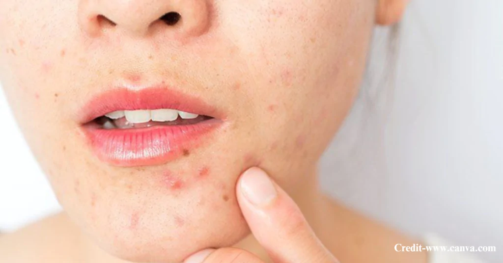 What Causes Pimples?