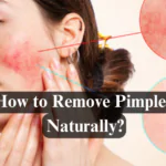 How to Remove Pimples Naturally and Permanently