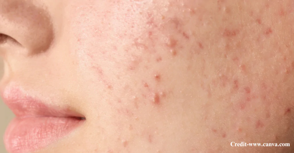 How to Remove Pimples for Good
