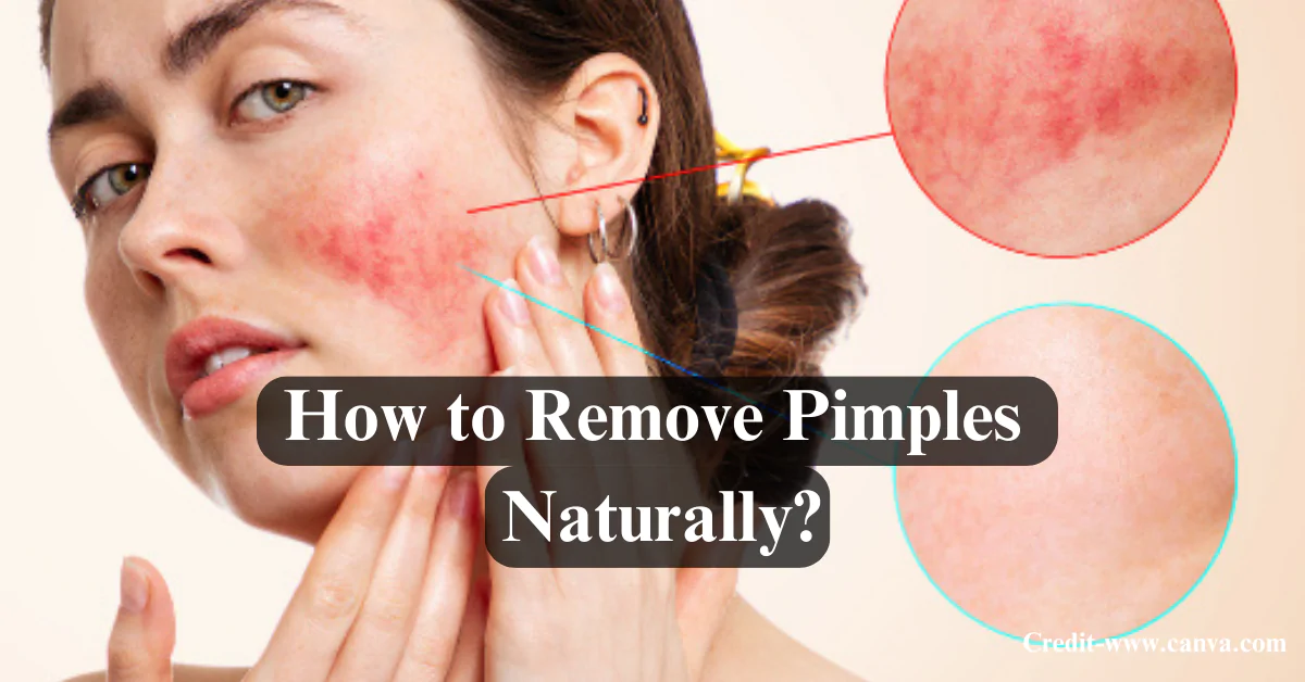 How to Remove Pimples Naturally and Permanently